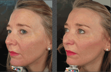 One Stitch Facelift  Micro Facelift London, UK Price & Cost