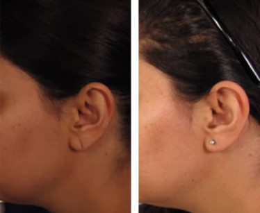 Ear-Lobe-Surgery