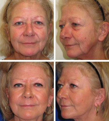 Chemical-Peel