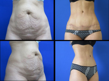 website abdominoplasty