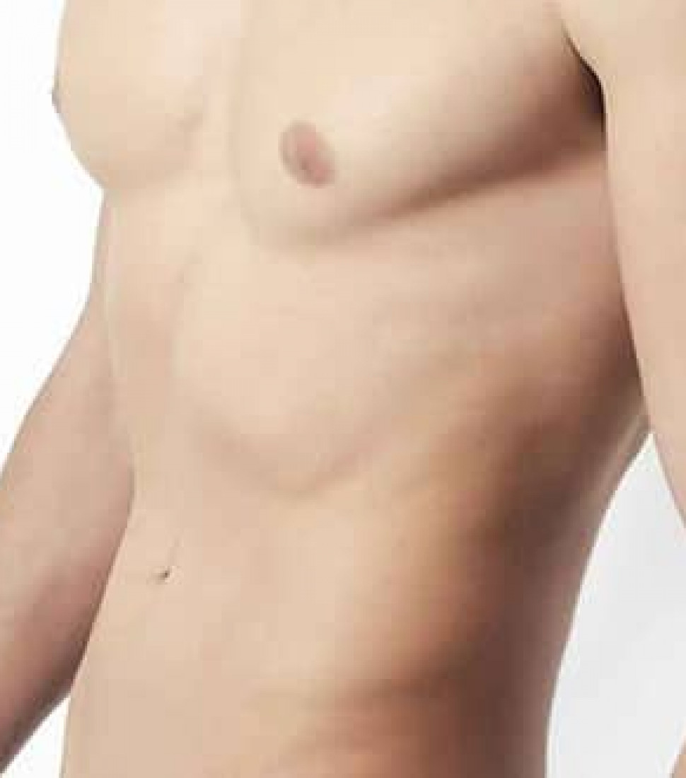vaser-liposuction