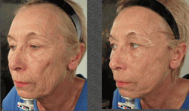 One Stitch Facelift  Micro Facelift London, UK Price & Cost